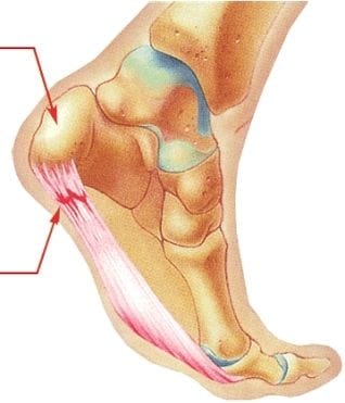 Plantar Fasciitis